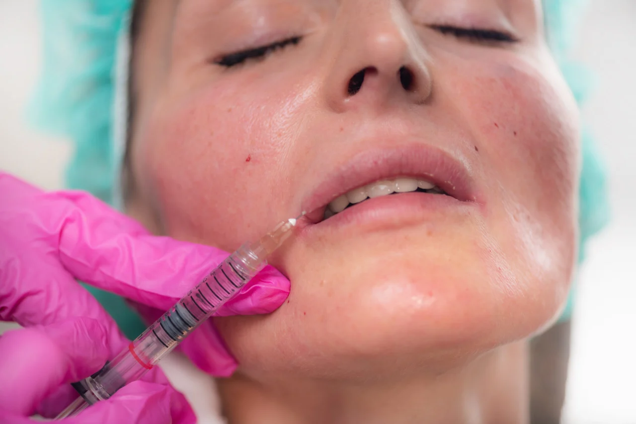 Lippenunterspritzung im Ästhetikzentrum Lampertheim