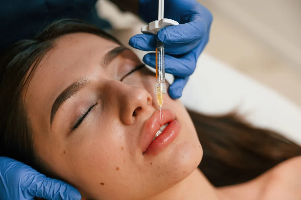 Lippenunterspritzung mit Hyaluronsäure